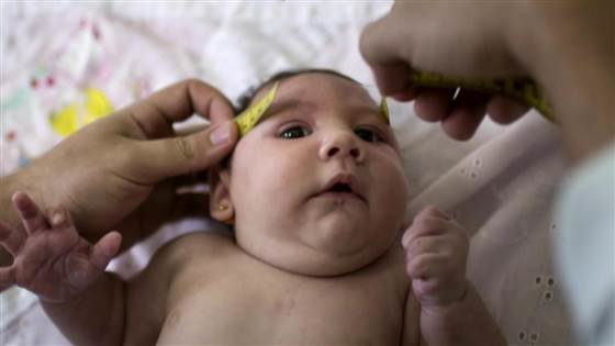 Photo courtesy of NBC News. Pregnant mothers infected with the Zika Virus often give birth to babies with shrunken heads (also known as microcephaly). The Zika virus has been associated with the spike in the number of cases of shrunken heads in newborns.